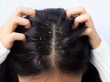 DANDRUFF TREATMENTS